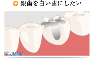 銀歯を白い歯にしたい